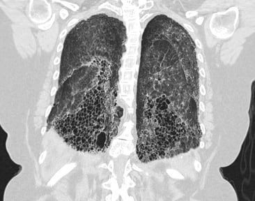 IPF sub-pleural